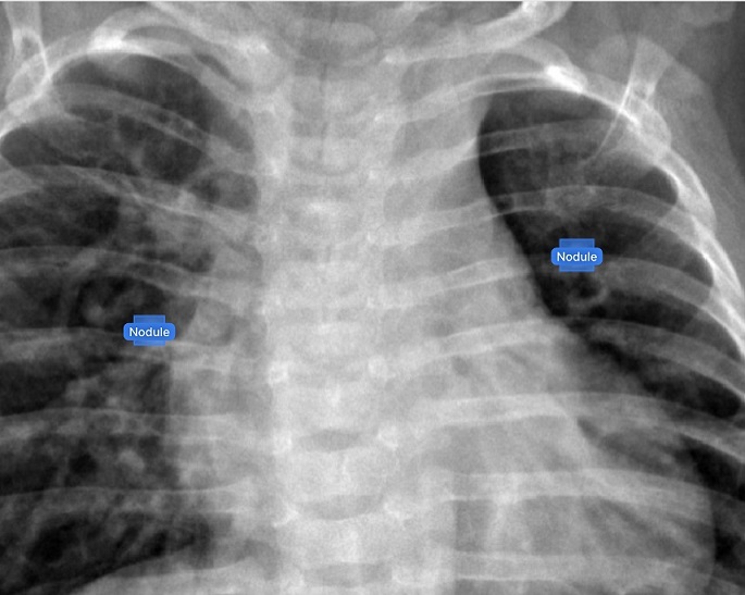 Imagen: El software VisiRad XR,  impulsado por IA, ha recibido la autorización 510 (k) de la FDA (Fotografía cortesía de IMIDEX)